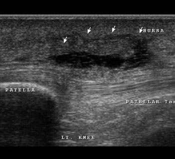 Prepatellar bursitis