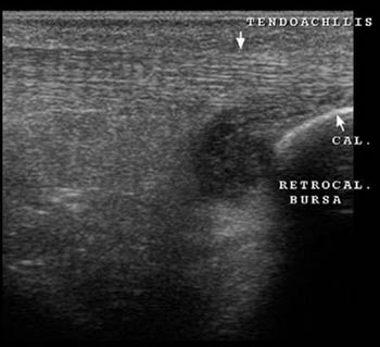 Retrocalcaneal bursitis