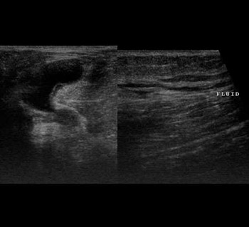 Ruptured Baker's Cyst